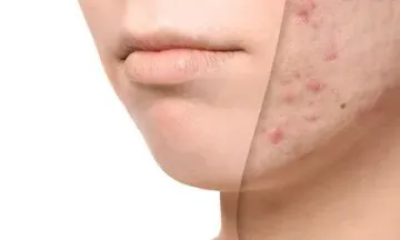 Are acne scars more than skin deep?