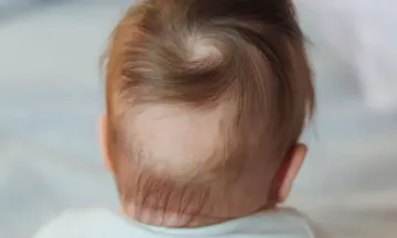 Alopecia Areata in Children - Signs & Treatment