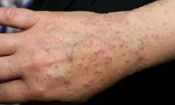 Battle Lichen Planus with Homeopathy