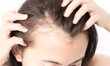 Homeopathy: Best Female Pattern Baldness Treatment