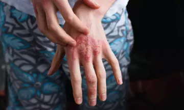 Eczema triggers and how to avoid them?