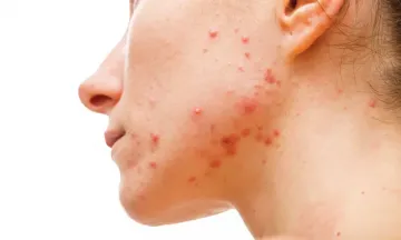 What causes monsoon acne and how to deal with it?