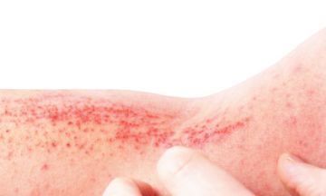 How to know if you have atopic eczema?