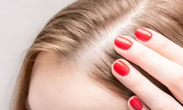 What causes baldness in women?