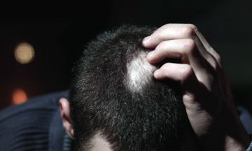 A Guide to Preventing StressRelated Hair Loss  Kerotin