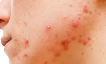 How to Treat Acne Before Scarring Occurs