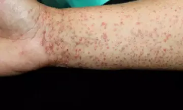 Lichen planus treatment in homeopathy