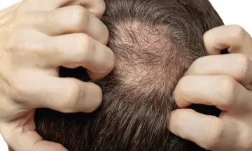 Why do men experience hair fall in the monsoon?