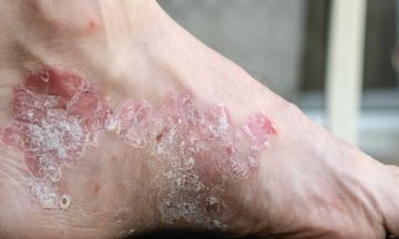 Psoriasis triggers that cause eruption