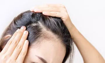 Why does alopecia areata occur Remedies  Treatment  Dr Batras
