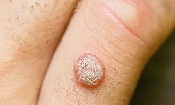 Homeopathy: A way to treat warts