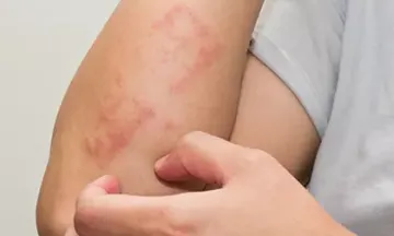 Monsoon & skin allergies