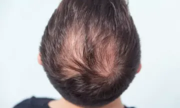 How to Fight Male Pattern Baldness with Homeopathy