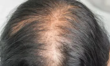 Do you want to leave your hair fall behind in this race Switch to  Homeopathy  Dr Batras