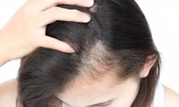 Hair Loss in Women  Toronto ON  FREEDOMclinic