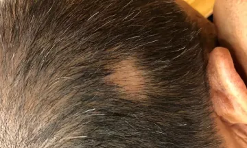 Is alopecia areata permanent?