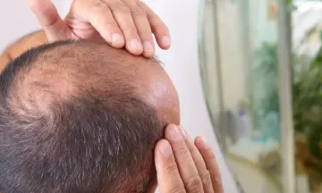 Reasons for hair loss in men