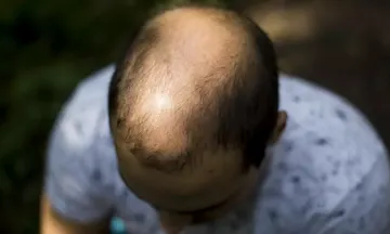 Male Pattern Baldness: Causes & Homeopathy Treatment