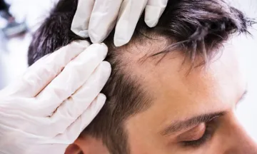 Hereditary Roots of Hair Loss