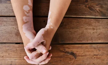 Latest Advances in Vitiligo Treatment