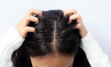 Dandruff and Hair Loss