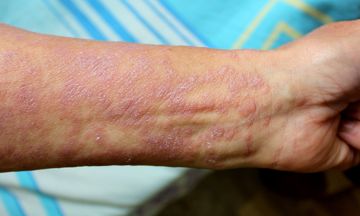  Lichen Planus with Natural Treatments