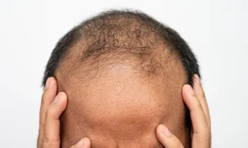 Can Alopecia Areata Turn Into Totalis?