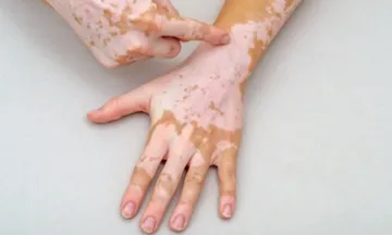 Can Vitiligo Make You Completely White? Understanding the Condition