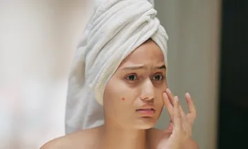 Can summer and heat cause acne breakouts?