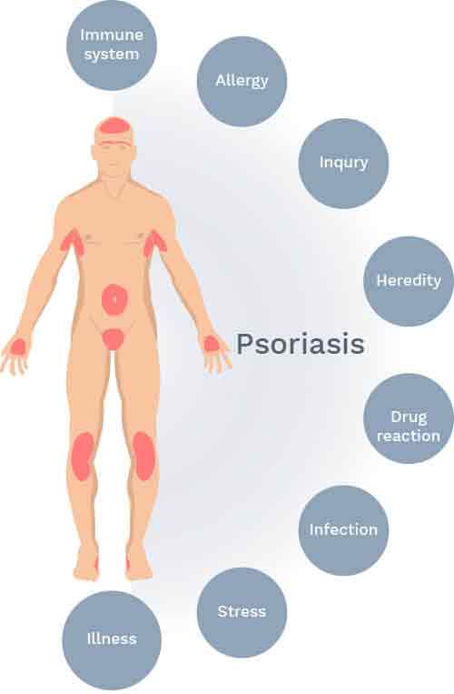Triggers Of Psoriasis 