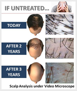 Losing Hair after Hair Transplant