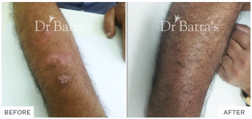 Before After Image of Arvindan Nair for Vitiligo Treatment with Homeopathy