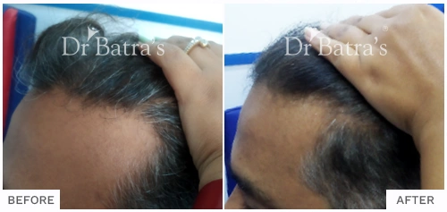 Before After Image of Amit Naik for AGA Male Treatment