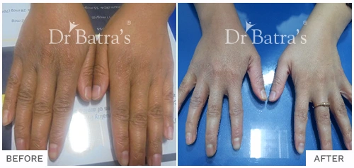 Before After Image of Anna Jaison for Eczema Treatment