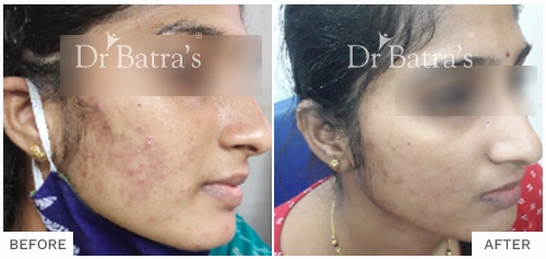 Before After Image of Archana Sambhaji Khilarefor AcneTreatment