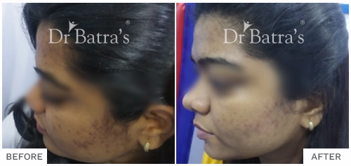 Before After Image of Chaitali Patil for Acne Treatment with Homeopathy