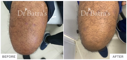 Before After Image of Devi Maravi for Eczema Treatment