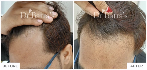 Before After Image of Dhirendra Kumar for AGA Male Treatment