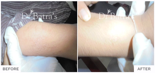 Before After Image of Evania Chitlapully for Eczema Treatment