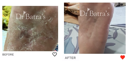 Before After Image of Kanta Devi for Psoriasis Treatment