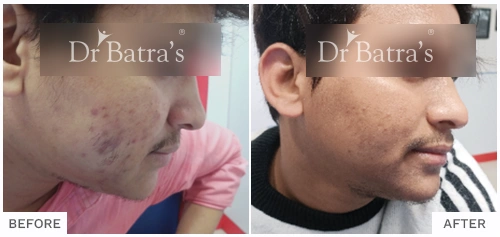 Before After Image of Labab Husen for Acne Treatment