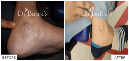 Before After Image of Mugdha Kulkarni for Vitiligo Treatment with Homeopathy