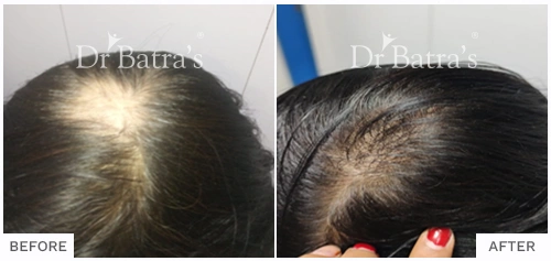 Before After Image of Maanvi Srivastava for Patchy Hair Loss Treatment