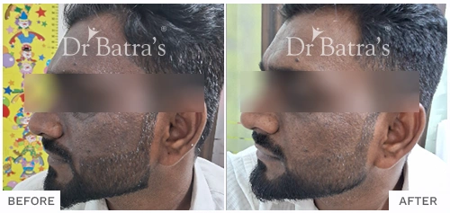 Before After Image of Madan Ahire for Melasma Treatment