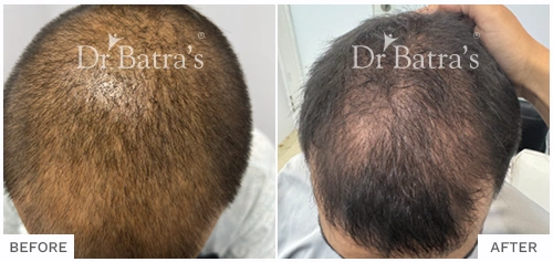 Before After Image of Manoj Kumar for Seborrheic Dermatitis Treatment with Homeopathy