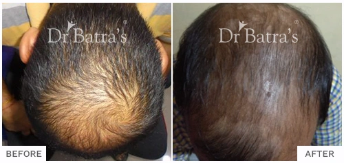 Before After Image of Pratyush Kumar for AGA Male Treatment