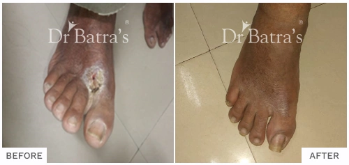 Before After Image of Purushottam Mohani for Eczema Treatment with Homeopathy