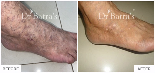 Before After Image of Parag Patil for Vitiligo Treatment with Homeopathy