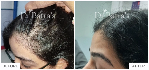 Before After Image of Pari Kala for Telogen Effluvium Treatment