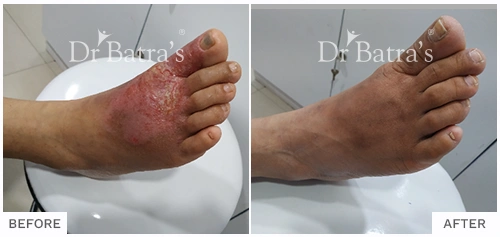 Before After Image of Rehana Jaleel for Eczema Treatment with Homeopathy